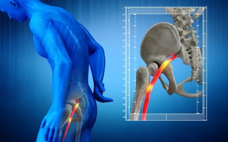 pinched-human-sciatic-nerve-anatomical-vision-3d-render-picture-id1207673372